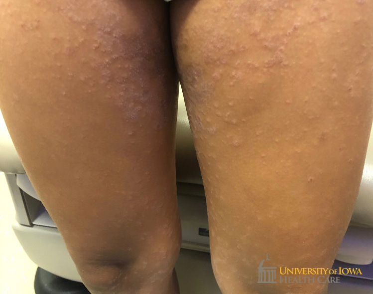 Hypopigmented to violaceous scaly papules and plaques on the medial thigh and lower legs. (click images for higher resolution).